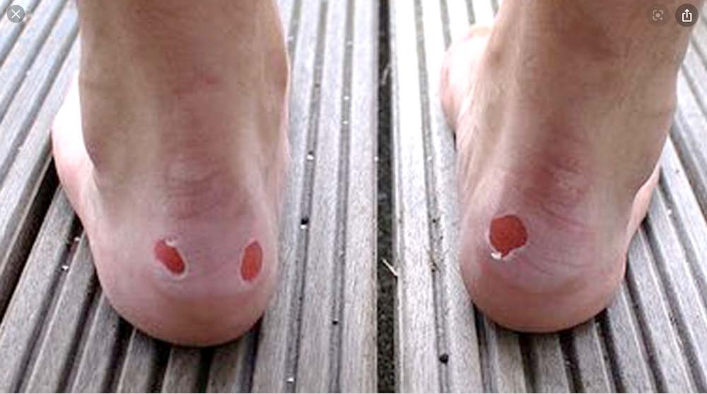 The Blister Triangle: Preventing and Treating Blisters at Home and